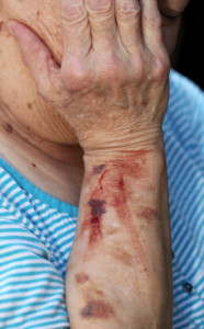 Elder Abuse Signs and Symptoms